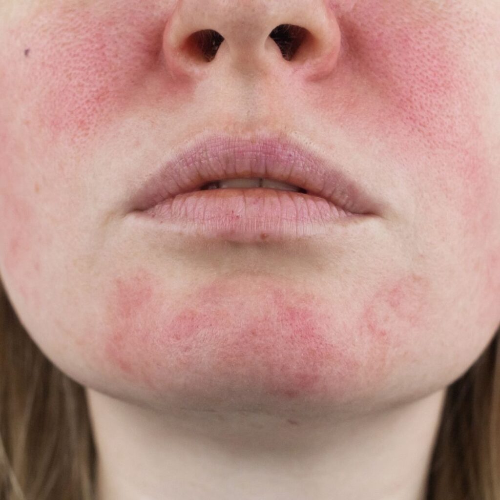rosacea treatment in Sheffield