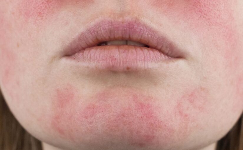 rosacea treatment in Sheffield