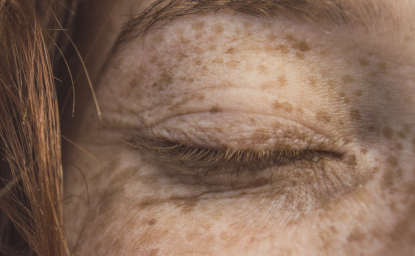 skin treatments Sheffield