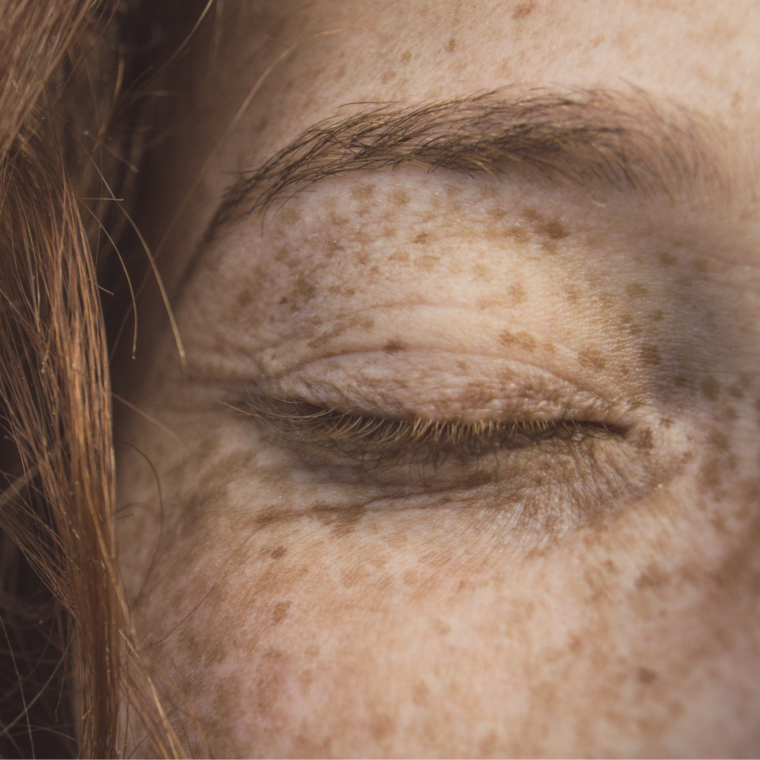 dry skin clinic Sheffield treatments