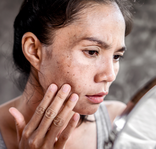 skin pigmentation treatments from Sheffield skin clinic