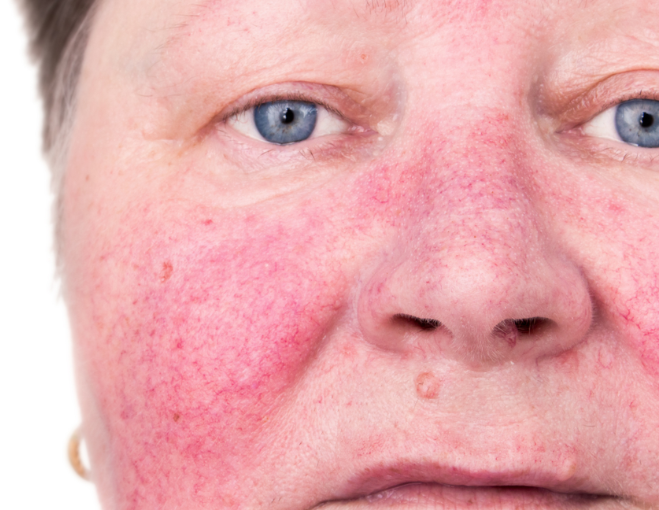 rosacea treatments from skin clinic in Sheffield