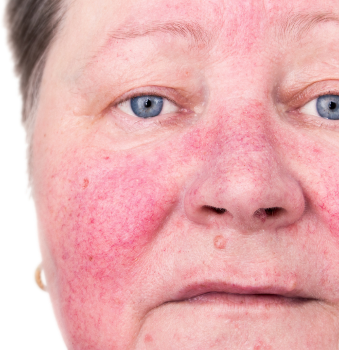 rosacea treatments from skin clinic in Sheffield