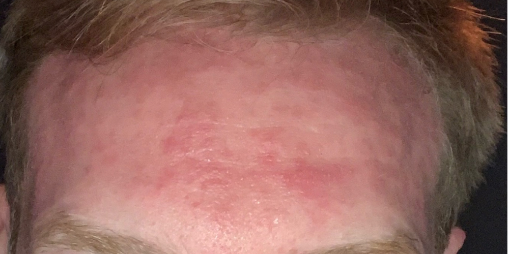 skin condition treatment clinic Sheffield - before