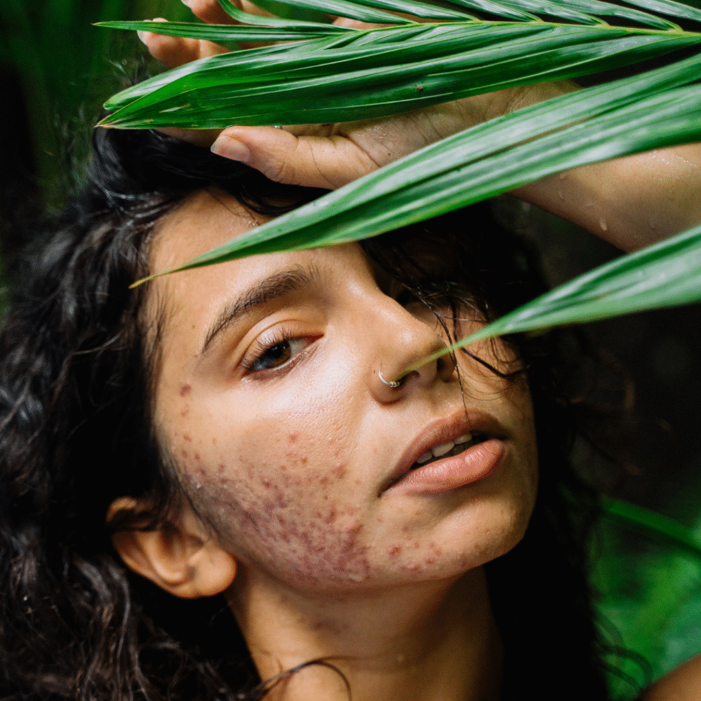 Acne treatments Sheffield