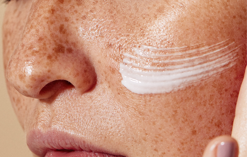 Close-up of skin showing pigmentation concern, illustrating sun exposure and pigmentation link
