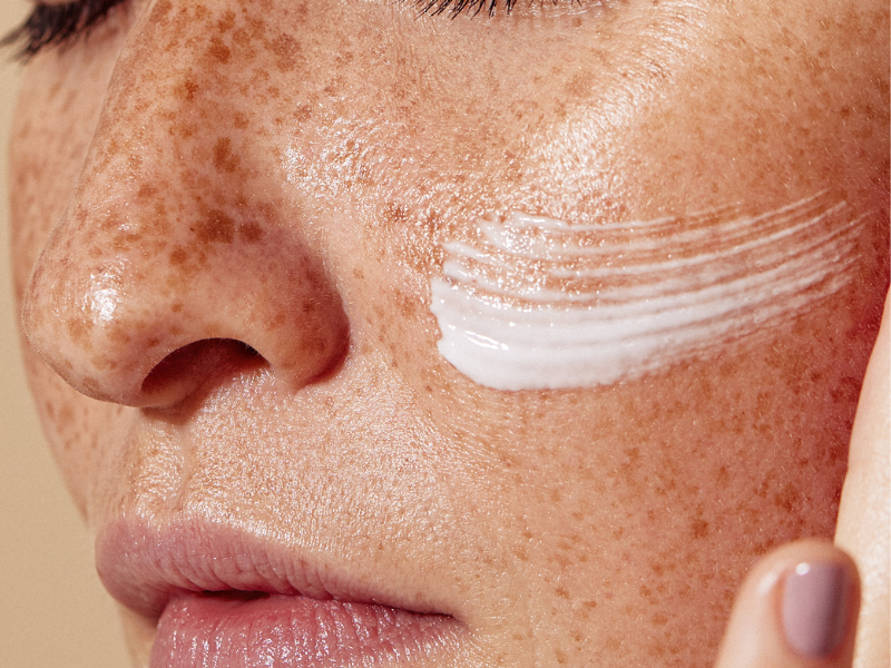 Close-up of skin showing pigmentation concern, illustrating sun exposure and pigmentation link