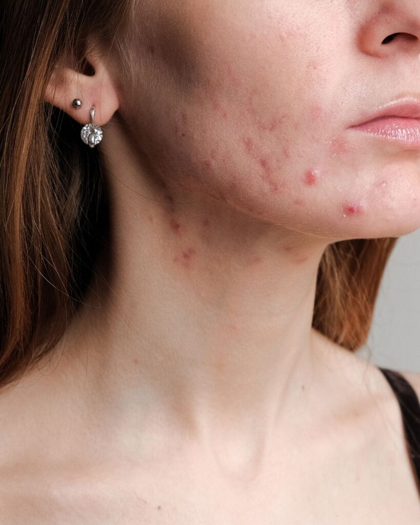 Adult acne treatment in Sheffield