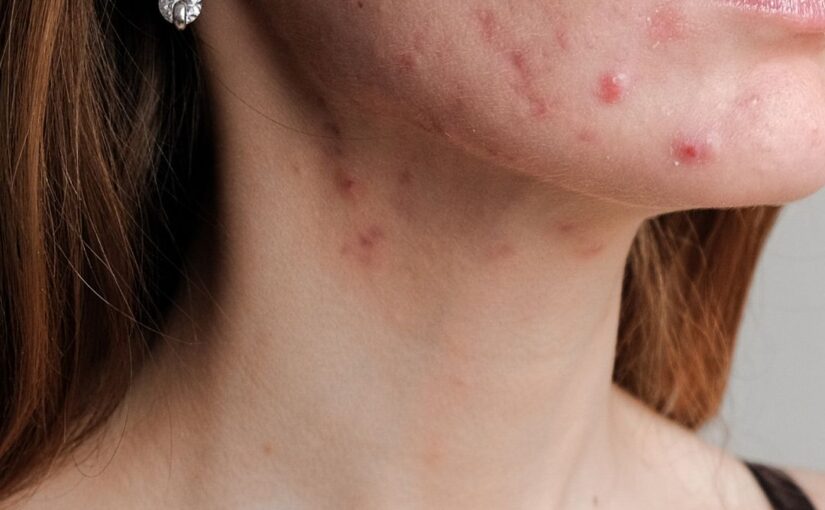 Adult acne treatment in Sheffield