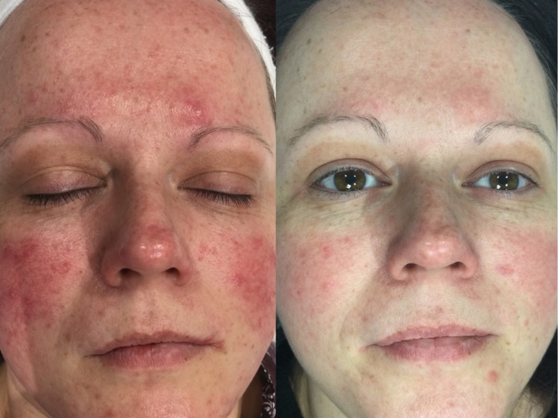 Rosacea treatment in Sheffield
